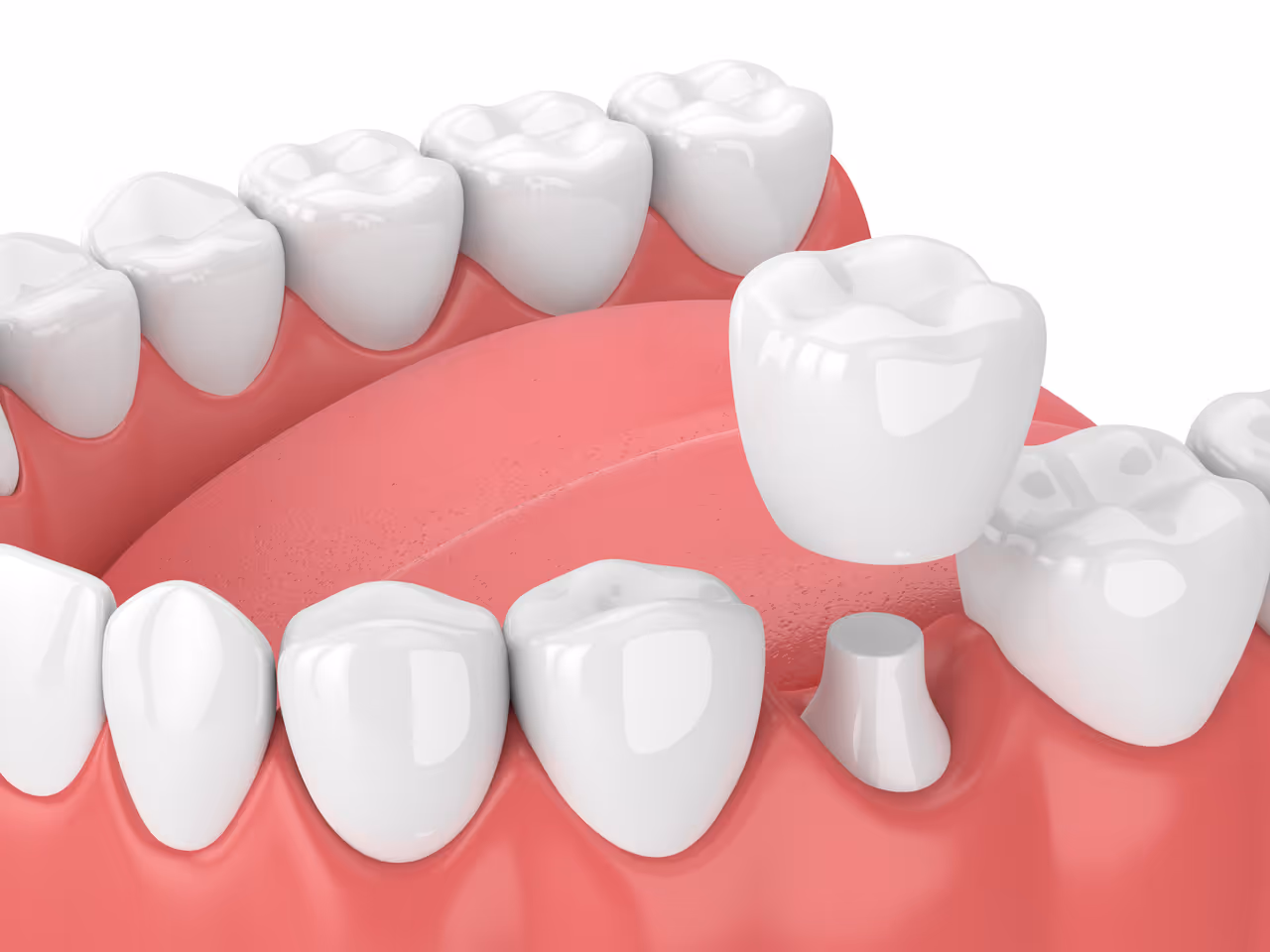 How Painful is Getting A Crown on Your Tooth?